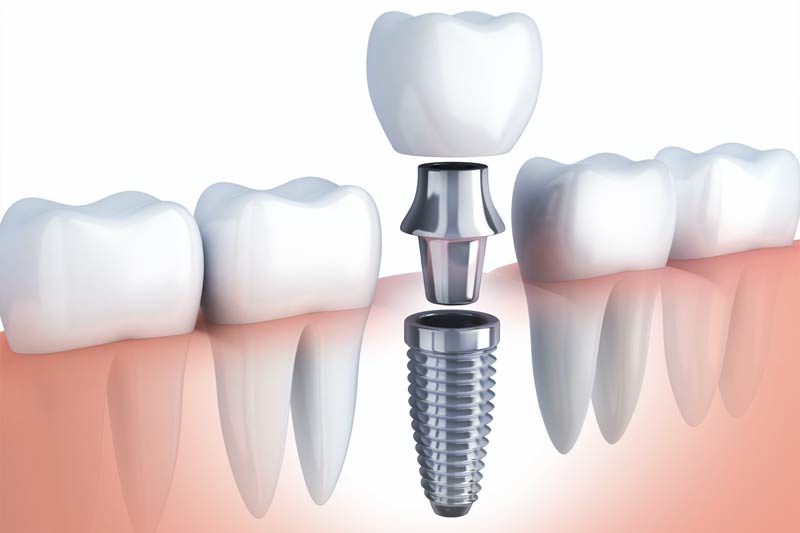 Implants Dentist in Springs