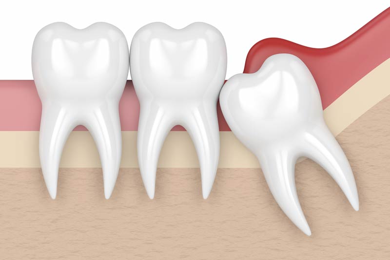 Wisdom Tooth Removal in Springs